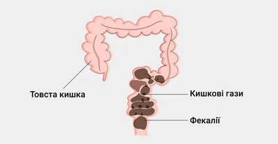 Запор у взрослых что делать и как лечить