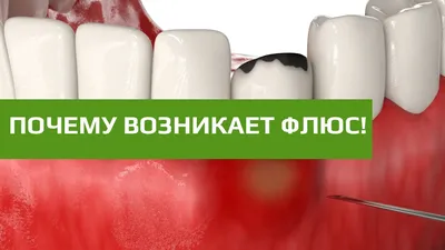 Что такое флюс зуба? Как лечить?