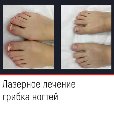 Удаление грибка лазером - Лазерное лечение грибка ногтей в Минске | LINLINE