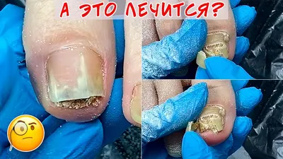 Onychogryphosis and toenail fungus / How to help the nail? - YouTube
