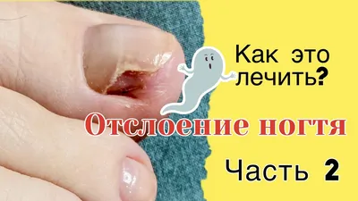 Онихомикоз: обработка ногтя | Грибок на ногтях | Медицинский педикюр |  Onychomycosis. Nail treatment - YouTube