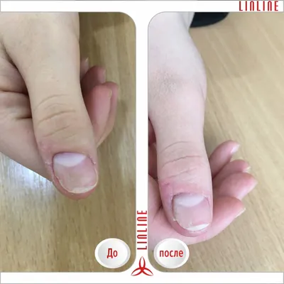 Удаление грибка лазером - Лазерное лечение грибка ногтей в Минске | LINLINE