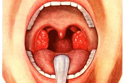 Как выглядит здоровое и больное красное горло у ребенка какими в норме  должны быть миндалины