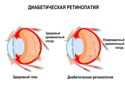 Пигментный ретинит у ребенка: причины, диагностика, симптомы