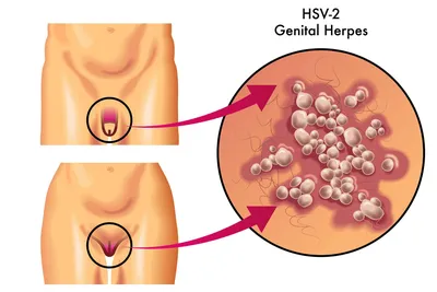 Лечение генитального герпеса - Медицинский центр Семья | Липецк
