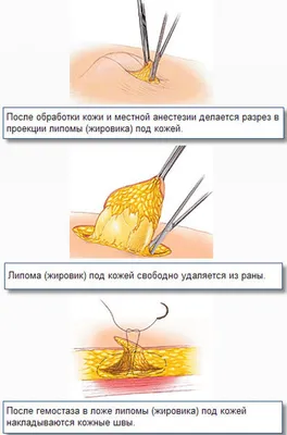 Уход за раной после удаления липомы | Медицинский центр Эра