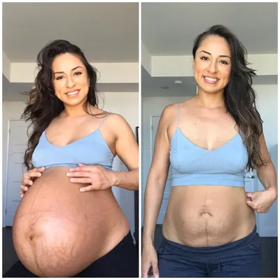Женщина показала, как выглядит живот через 8 недель после родов