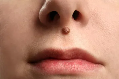 Меланома слизистых оболочек: рта, носа, губ