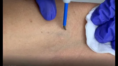 Удаление лазером новообразований на коже в Москве в Клинике подологии Полёт
