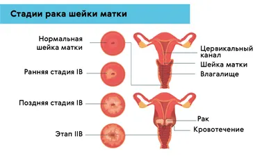 Лечение вируса папилломы человека (ВПЧ) у женщин и мужчин