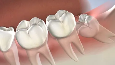 Удаление зуба мудрости - сложное удаление - стоматология в Раменках