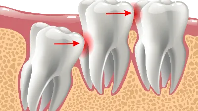 Боль после удаления зуба мудрости: какие симптомы нормальны, а что должно  насторожить - полезная информация от врачей стоматологии доктора Фролова