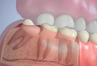 Зуб мудрости — когда появляется, нужно ли его удалять, как проходит восьмая  процедура удаления? | Стоматологическая клиника Слаутинского
