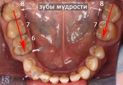 Имплантация зубов с ортодонтической подготовкой и тотальное протезирование  зубов керамикой