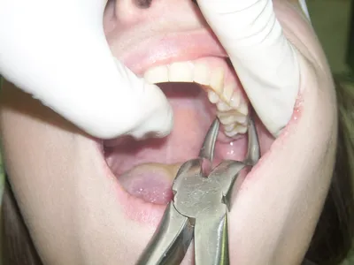 Удаление зуба мудрости на верхней челюсти без боли.