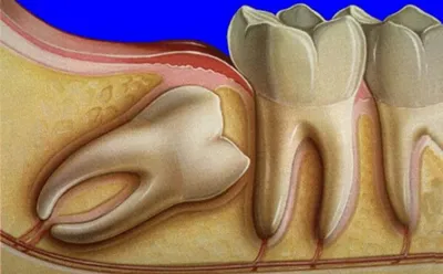 Болит зуб мудрости: как снять боль, что делать |