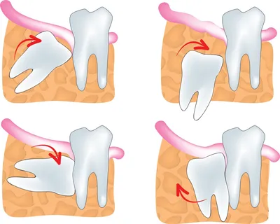 Зуб мудрости: режется и растет восьмерка, лечить или удалять в стоматологии