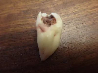 Файл:Вырванный зуб.JPG — Википедия