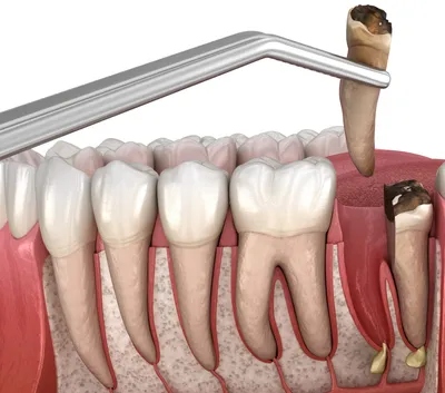 Киста после удаления зуба: кто виноват и как лечить заболевание |