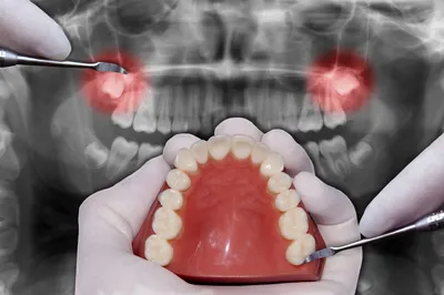 Какие осложнения вызывают зубы мудрости, и что с этим делать, советы  стоматологов центра \