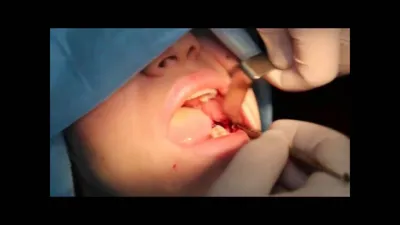 Ретинированный зуб. Удаление ретинированного дистопированного зуба в  Москве. Цены на удаление. Фото, отзывы