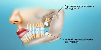 Качественное удаление зуба мудрости в Тюмени без боли