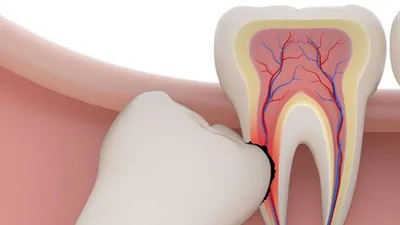 Нужно ли удалять зуб мудрости? | Стоматологическая клиника Слаутинского