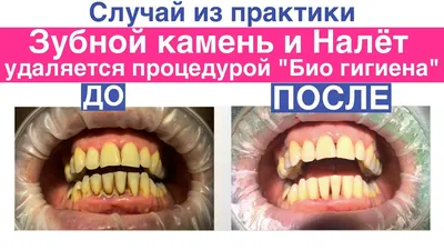 Зубной камень причины появления и как удалять. Как появляется зубные  отложения из зубного налета. - YouTube