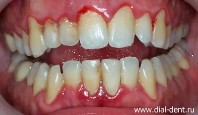 Снятие зубных отложений и лечение гингивита