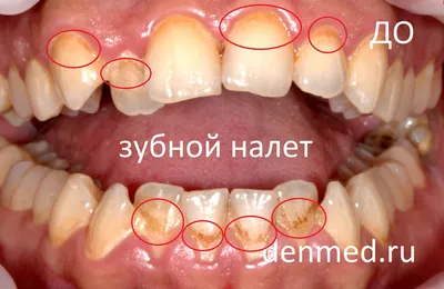 Гигиену полости рта начинаем с удаления зубного камня - КДМ КДМ