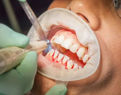 Каким бывает зубной камень? | Лечение зубного камня в Перми
