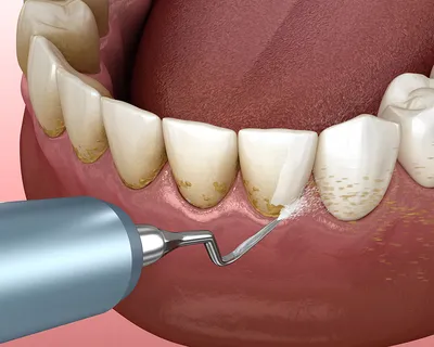 Зачем нужно удаление зубного камня? | Владимир Сойфер Отзывы | Дзен