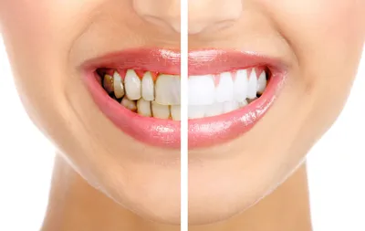 Как удалить зубной камень, и почему он появляется? - Статья стоматологии  Доктор Келлер в Батайске