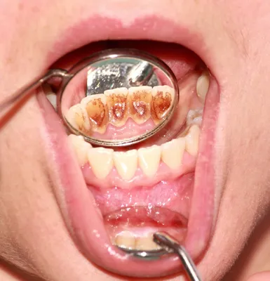 Что такое зубной камень? Виды лечения зубного камня, профилактика