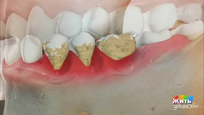 Зубной камень – Причины, фото и как избавиться от зубного камня –  стоматологический портал MyDentist.ru