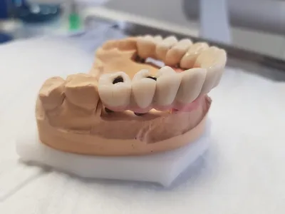 Зубной мост [виды и цена на 2, 3, 4 зуба, как ставят]