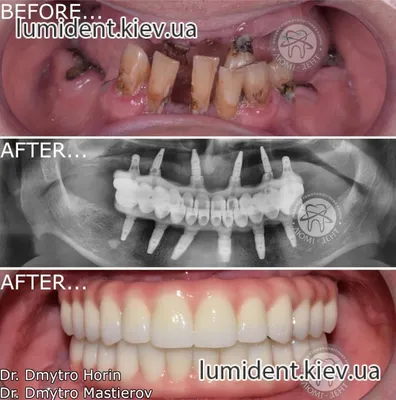 99 Фото] Протезирования Зубов Мостов - ЛюмиДент