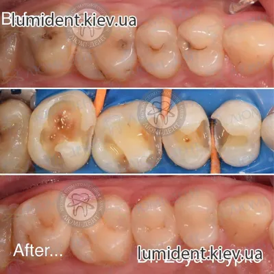 Пломбирование Зубов [229 Фото До После] Киев Люми-Дент