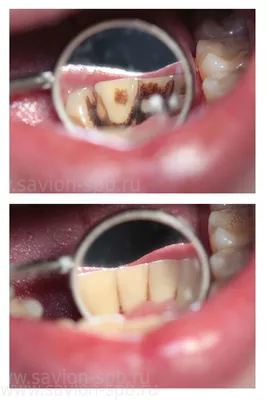 Чистка и отбеливание зубов фото до и после