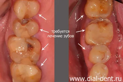 Комплексное лечение зубов