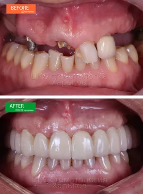 Восстановить все зубы при помощи имплантов. Стоимость тотального  протезирования зубов Харьков 2022