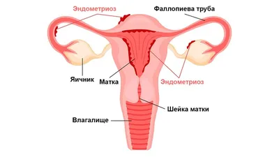 Эндометриоз матки: симптомы, причины, лечение